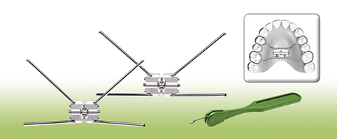 Gaumennaht - Erweiterungsschrauben
