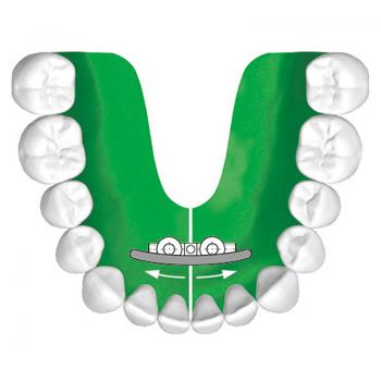 Preview: Unterkieferbogenschraube