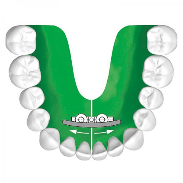 Unterkieferbogenschraube